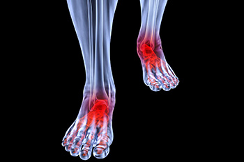 Arthritic foot and ankle care treatment, foot arthritis treatment in the Harris County, TX: Houston, Kingwood, Humble, Spring;  Atascosa County, TX: Atascocita; Montgomery County, TX: The Woodlands, Conroe, New Caney areas