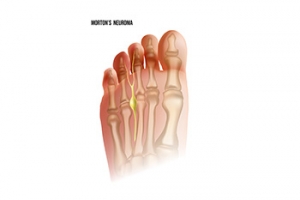 Understanding Morton&#039;s Neuroma