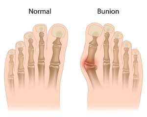 Deciding What to Do About a Bunion