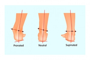 Causes of Overpronation