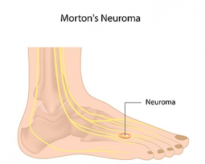 What Are the Treatments for Morton&#039;s Neuroma?