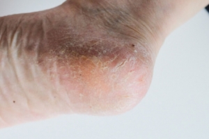 Facts About Cracked Heels