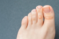 How to Get Rid of Foot Corns