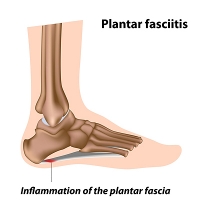 When Should I See a Podiatrist for Plantar Fasciitis?