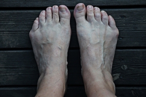 Tailor&#039;s Bunion Symptoms