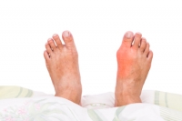 What Can Cause Bunions?