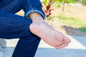 Plantar Warts Can Cause Discomfort