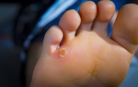 Complications Associated With Corns on the Feet
