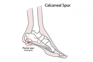 Causes and Remedies for Heel Spurs