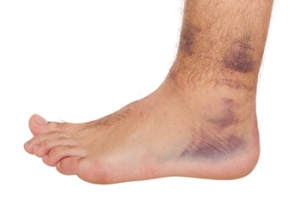 Taking Time for a Sprained Ankle to Heal