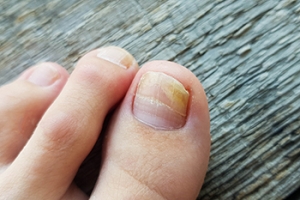 Dealing With Toenail Fungus
