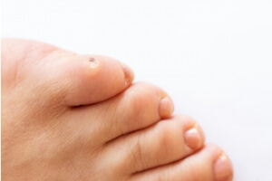 Professional Removal of Corns