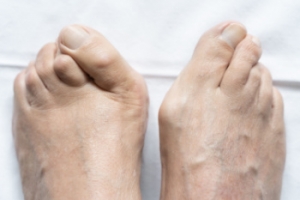 Types of Toe Deformities
