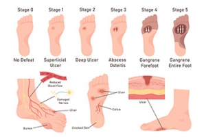 Pressure Injuries Versus Diabetic Foot Ulcers