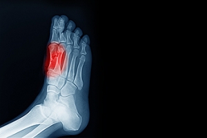 Sesamoiditis and Its Link to Metatarsalgia